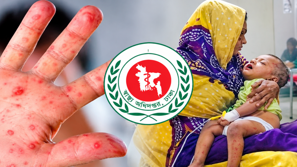 হামের উপসর্গে আরও তিন শিশুর প্রাণহানি